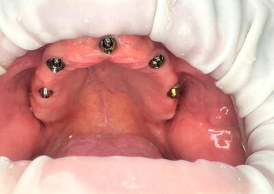 Procedimiento Implantes dentales Admodum.