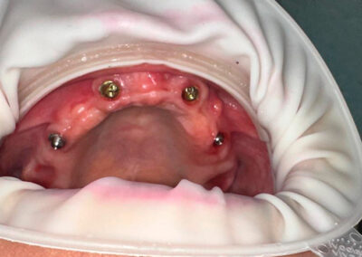 Procedimiento Implantes dentales Admodum.