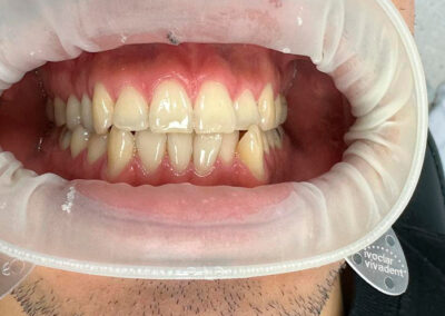 Estética dental, Blanqueamiento.