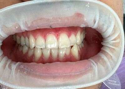 Estética dental, Blanqueamiento.