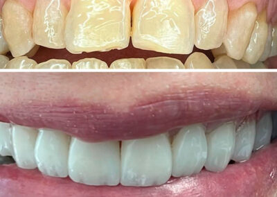 Estética dental, Carillas de Zirconio.