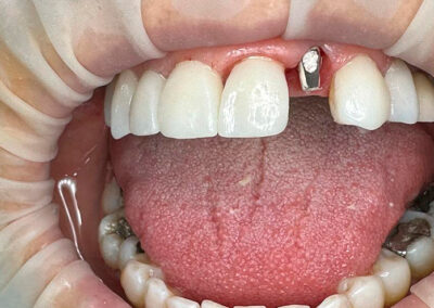 Procedimiento Implante Dental.