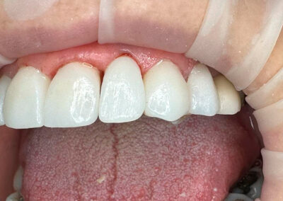 Procedimiento Implante Dental.