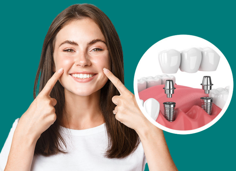 Implante dental puente