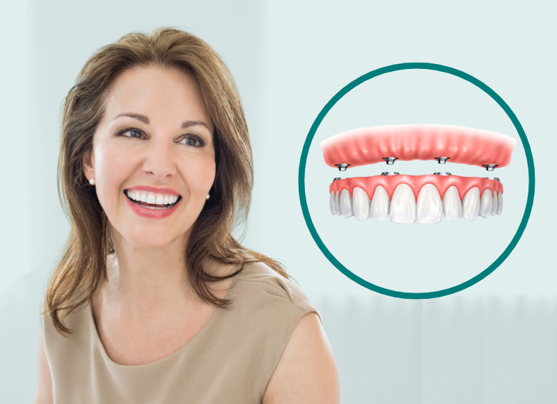 Implante dental arcada completa